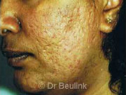 laser resurfacing acne scarring before (180)